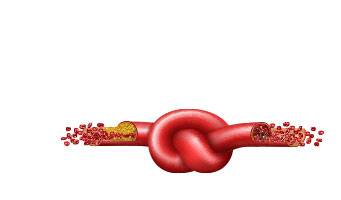 BLOOD CLOTS
